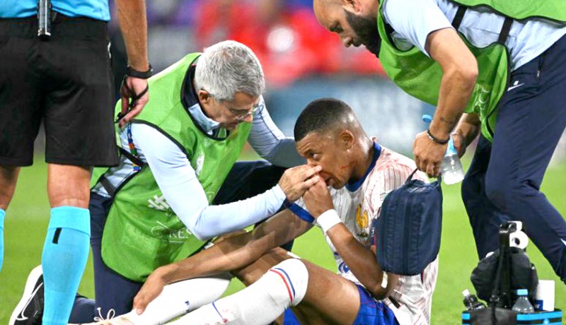 www.nusabali.com-mbappe-cedera-patah-tulang-hidung