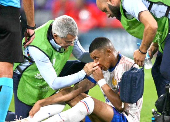 Nusabali.com - mbappe-cedera-patah-tulang-hidung