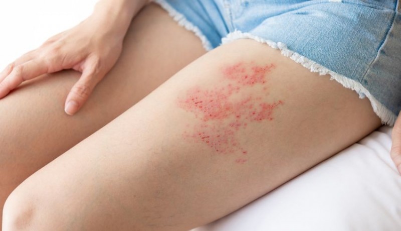 www.nusabali.com-pentingnya-pencegahan-herpes-zoster-penyakit-yang-mengintai-usia-lanjut