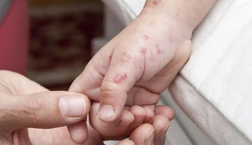 Penyakit Herpes Zoster Menjadi Ancaman Bagi Orang Dewasa