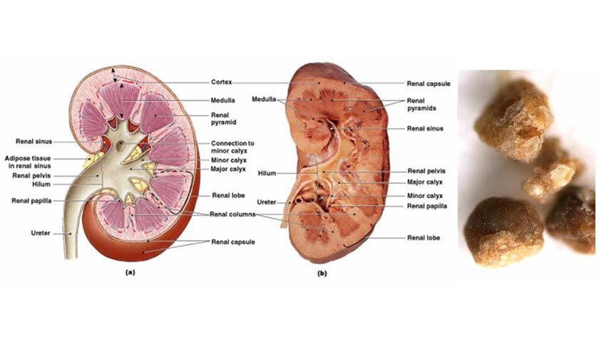 Nusabali Com Mengatasi Batu Ginjal Dengan Pijat Refleksi Terapi Moksa Dan Obat Herbal 1